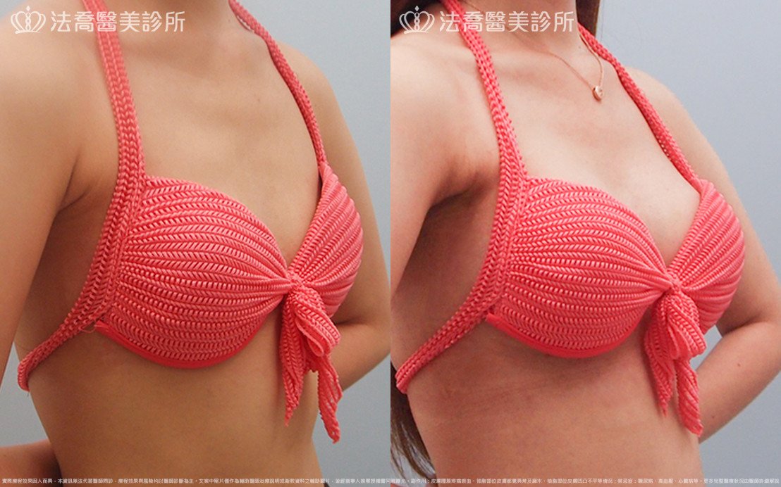 法喬醫美診所,邱浚彥,水滴果凍隆乳