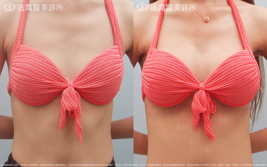 法喬醫美診所,邱浚彥,水滴果凍隆乳