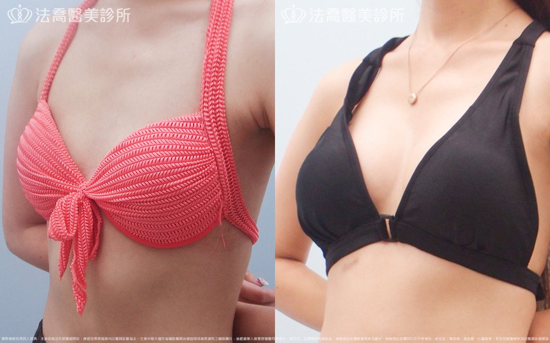 法喬醫美診所,邱浚彥,水滴果凍隆乳