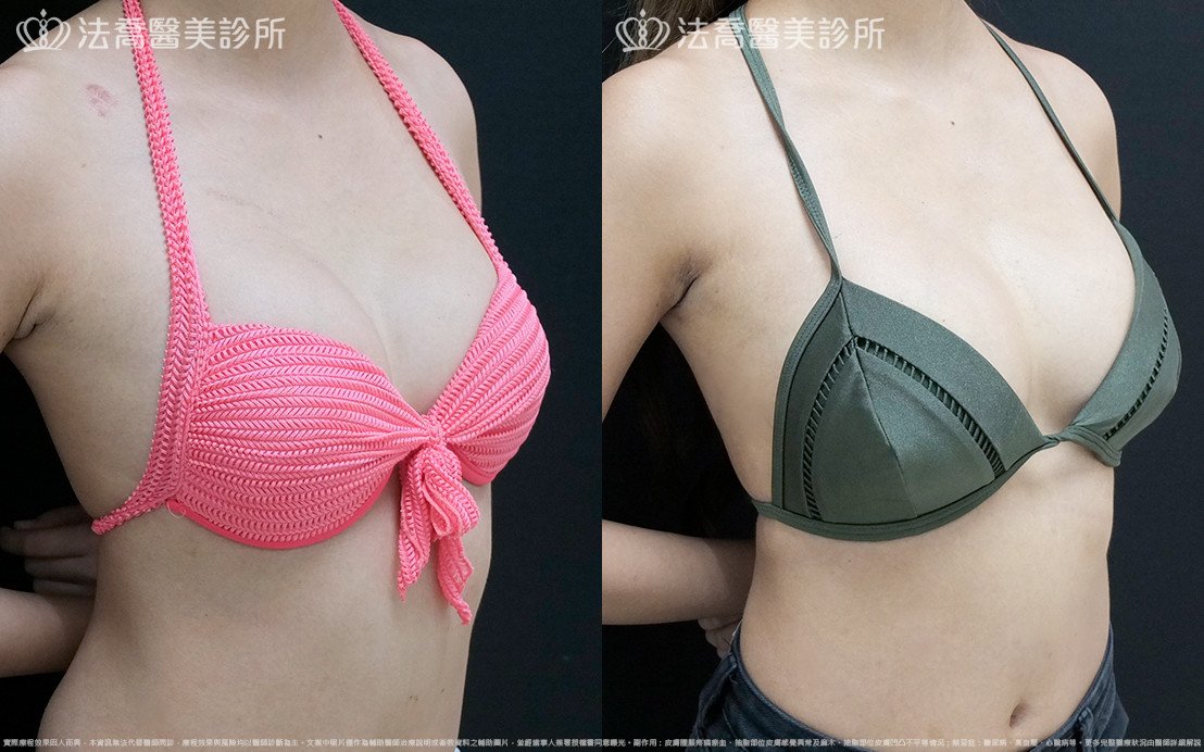 法喬醫美診所,邱浚彥,水滴果凍隆乳