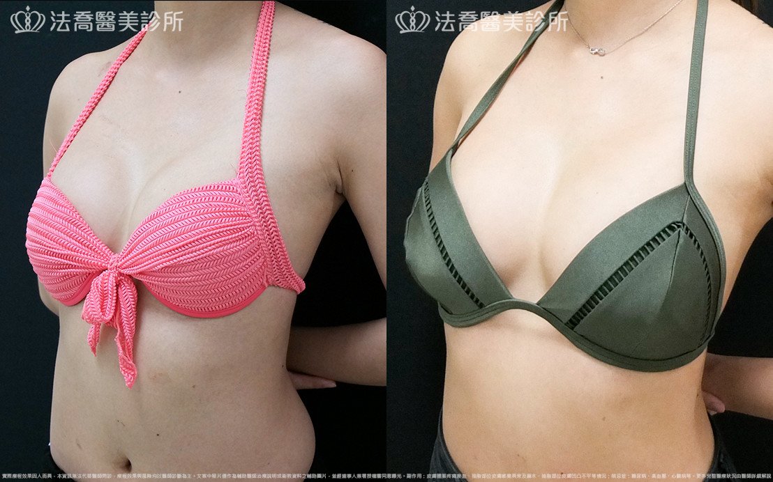 法喬醫美診所,邱浚彥,水滴果凍隆乳