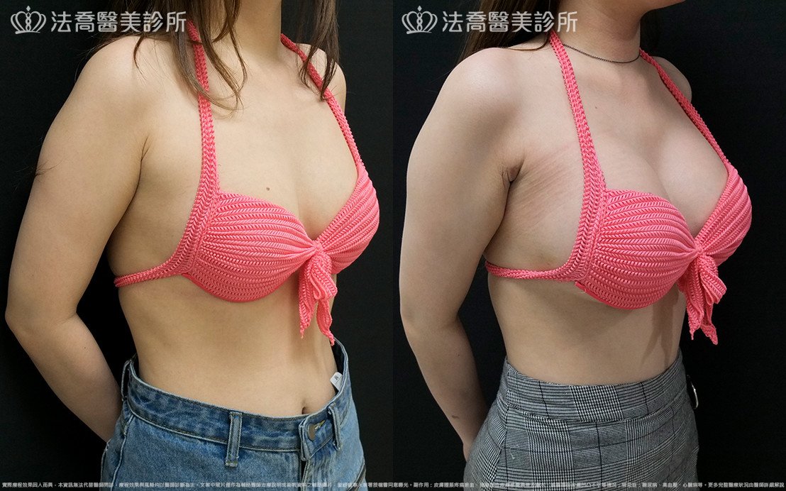 法喬醫美診所,邱浚彥,水滴果凍隆乳
