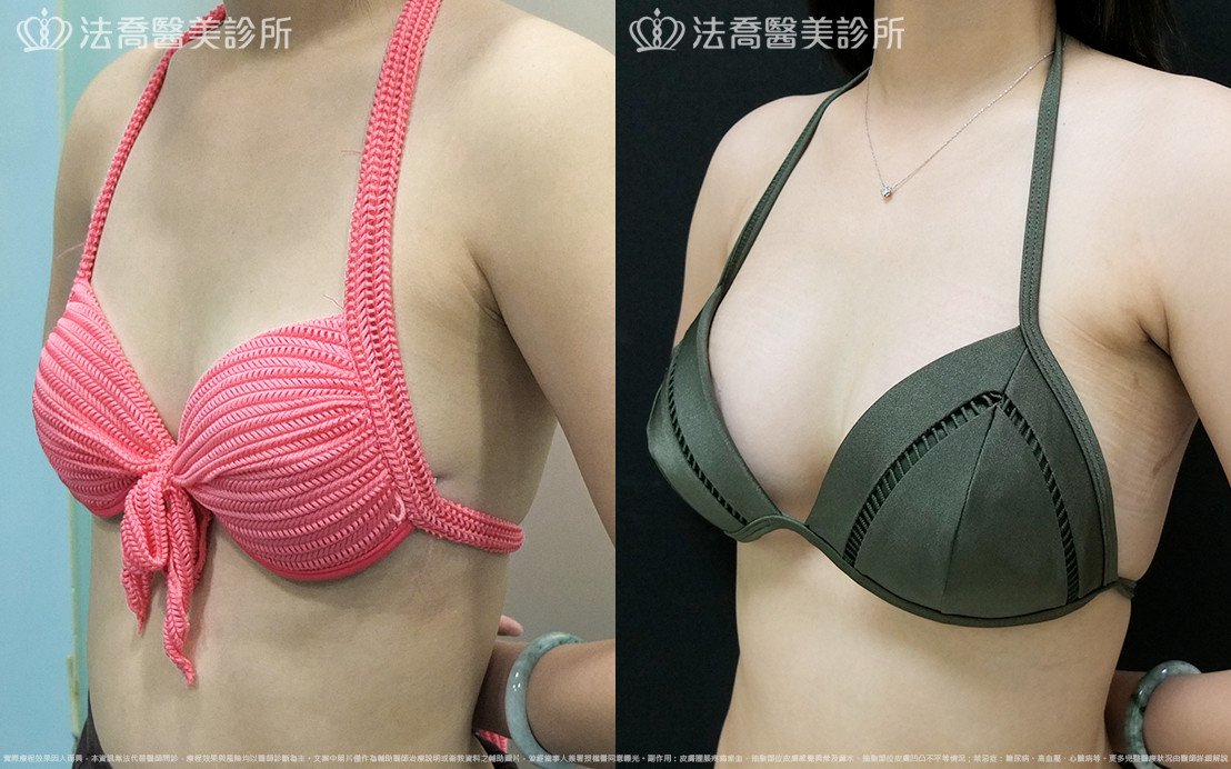 法喬醫美診所,邱浚彥,水滴果凍隆乳