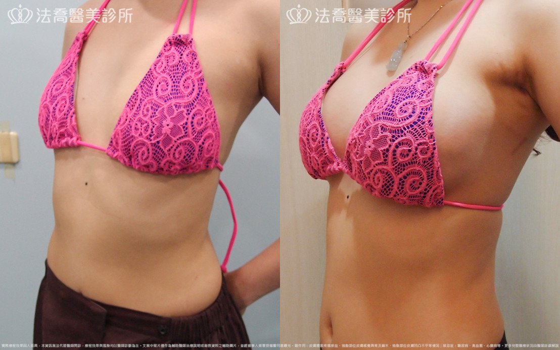 法喬醫美診所,邱浚彥,水滴果凍隆乳