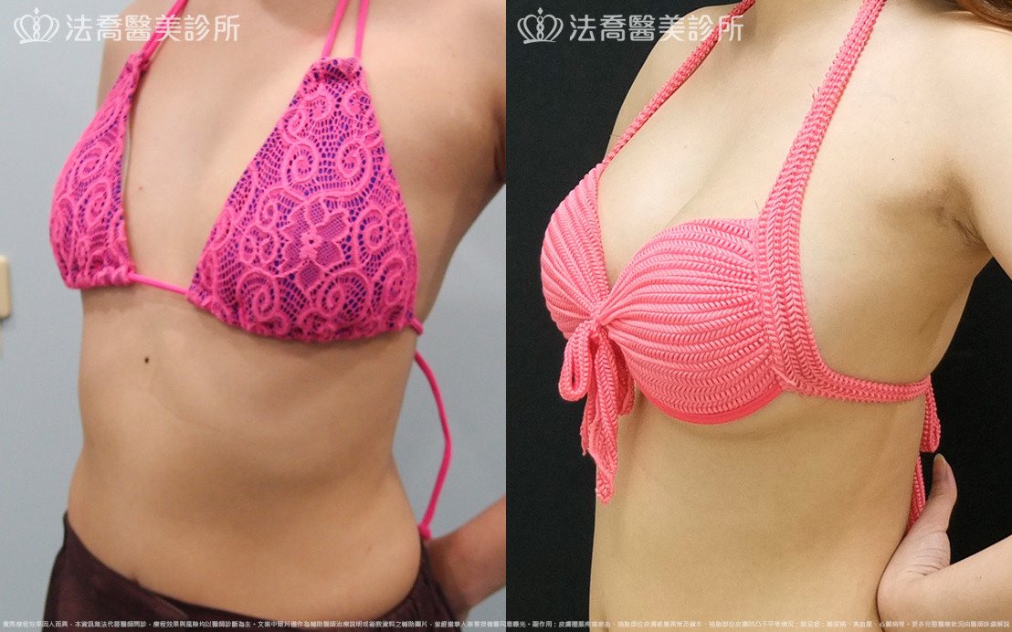 法喬醫美診所,邱浚彥,水滴果凍隆乳