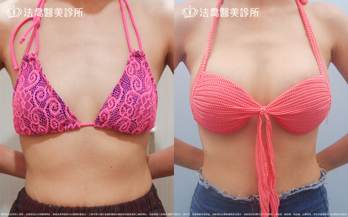 法喬醫美診所,邱浚彥,水滴果凍隆乳