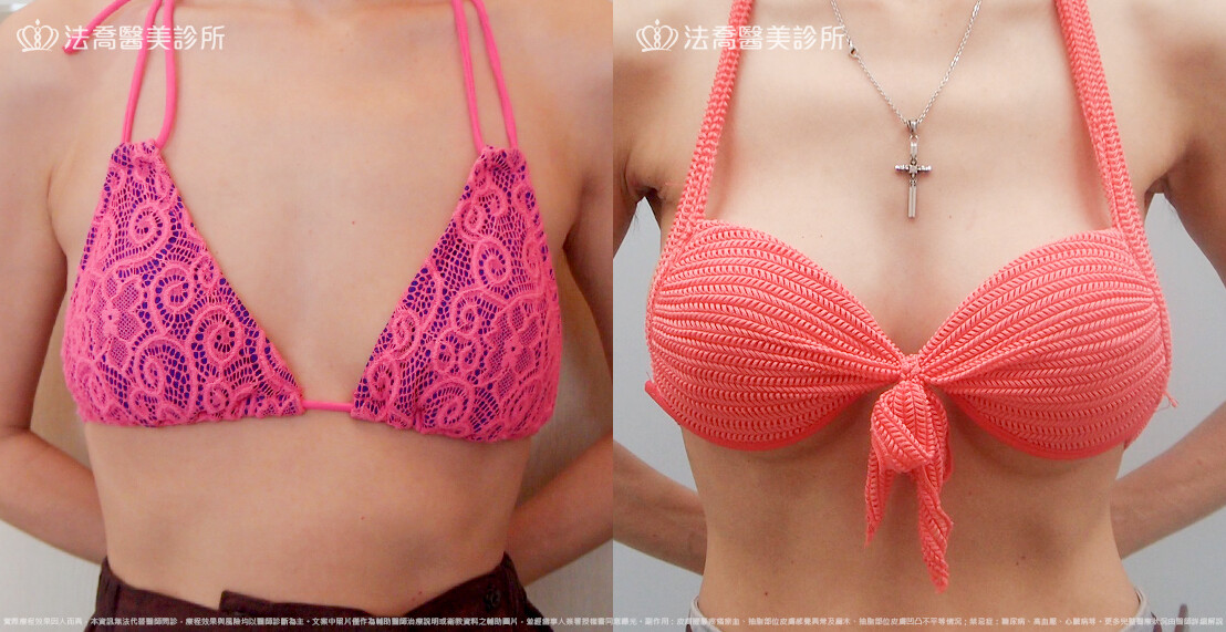 法喬醫美診所,邱浚彥,水滴果凍隆乳