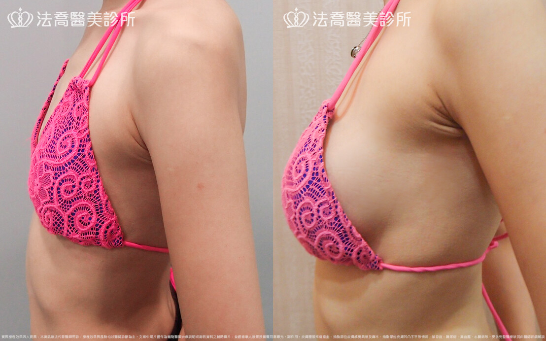 法喬醫美診所,邱浚彥,水滴果凍隆乳