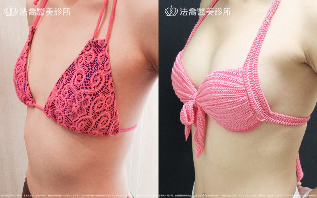 法喬醫美診所,邱浚彥,水滴果凍隆乳