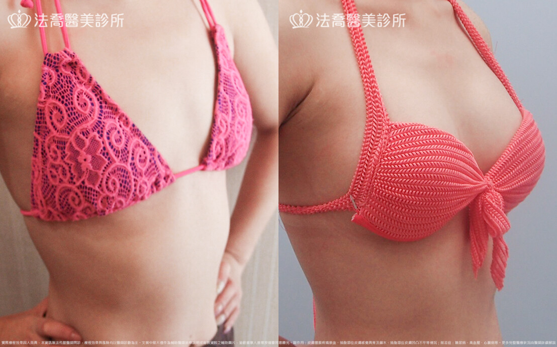 法喬醫美診所,邱浚彥,水滴果凍隆乳