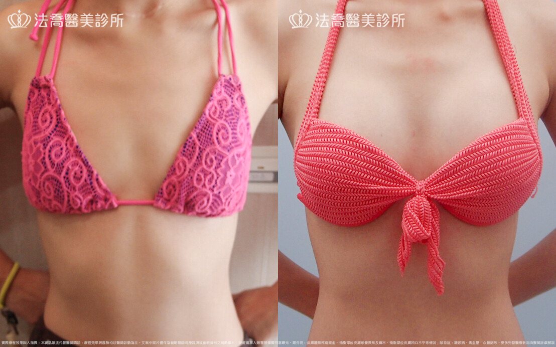 法喬醫美診所,邱浚彥,水滴果凍隆乳