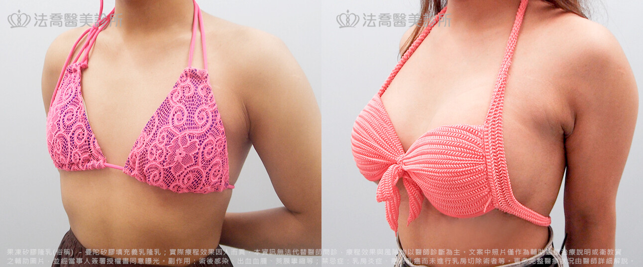 法喬醫美診所,邱浚彥,水滴果凍隆乳