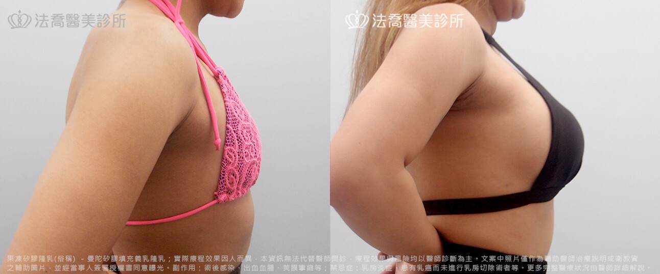 法喬醫美診所,邱浚彥,水滴果凍隆乳