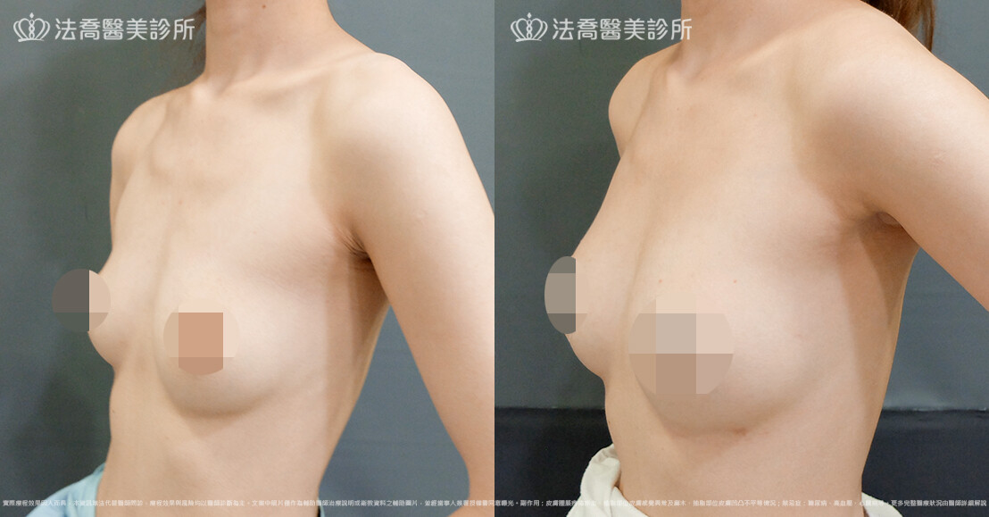 法喬醫美診所,邱浚彥,魔滴隆乳