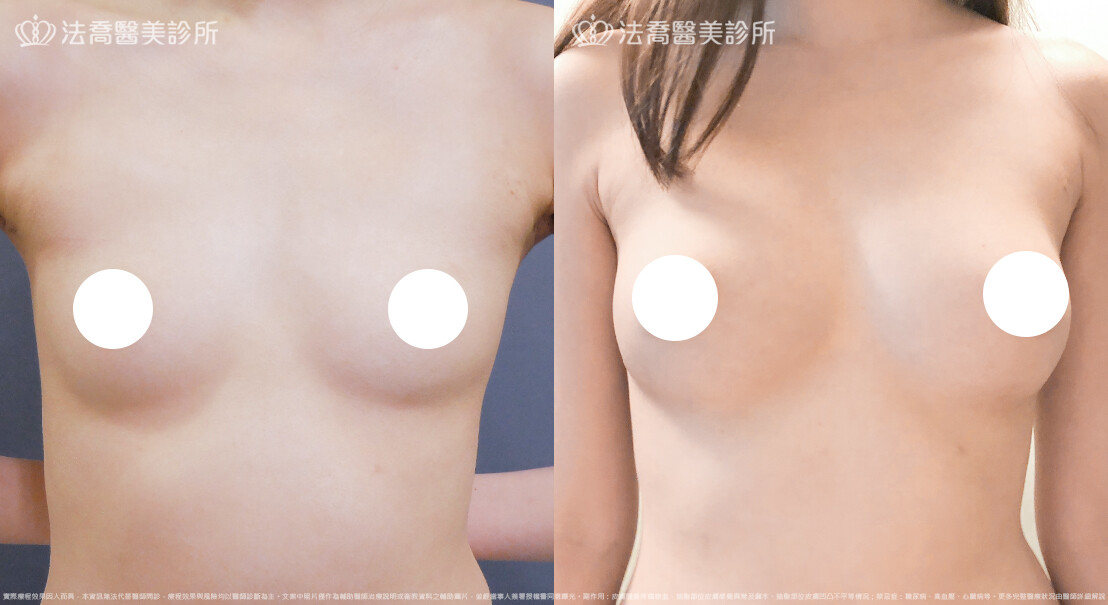 自體脂肪豐胸
