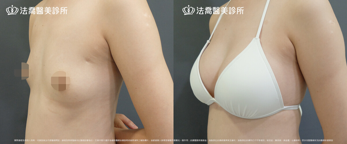 自體脂肪豐胸