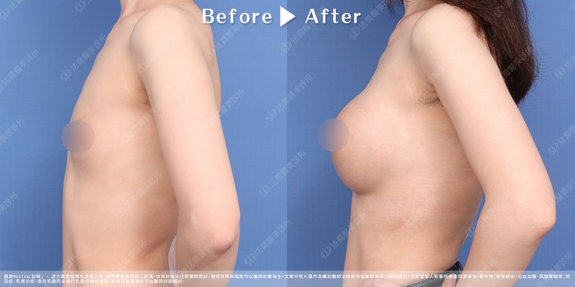 法喬醫美診所,魔滴隆乳