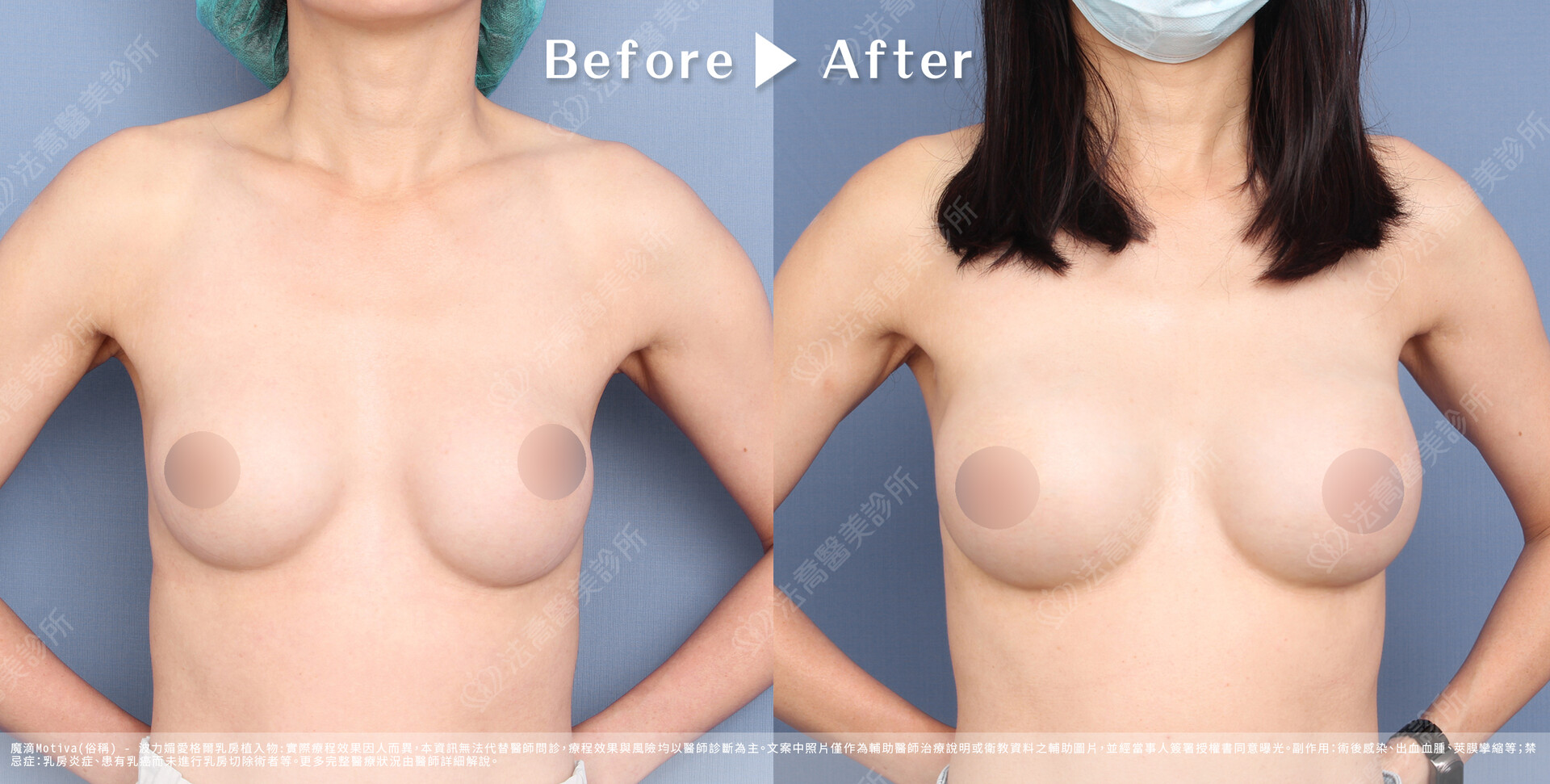 法喬醫美診所,魔滴隆乳