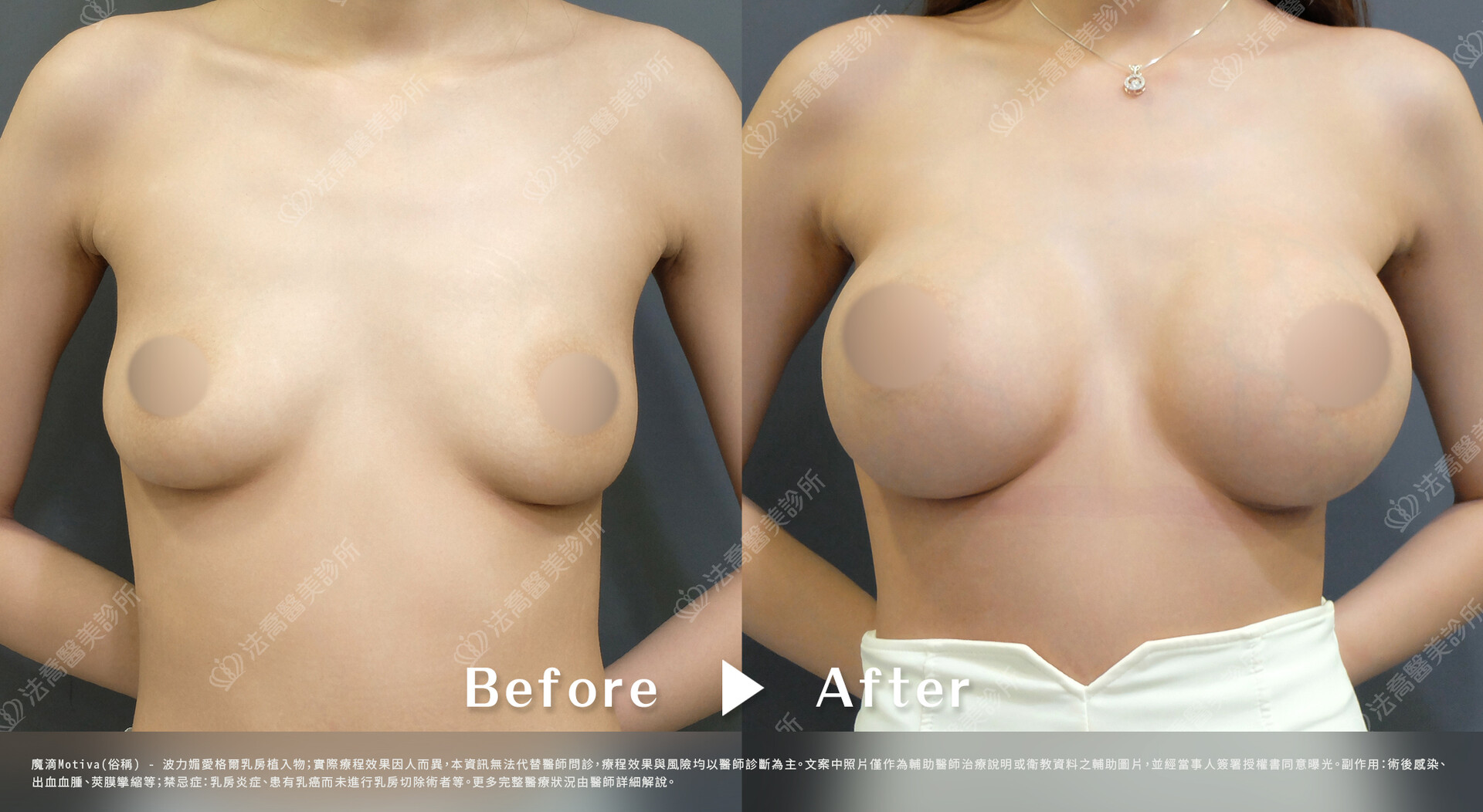 法喬醫美診所,魔滴隆乳