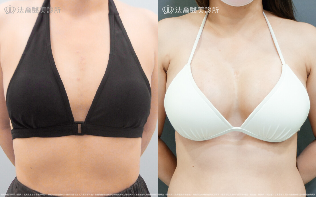 法喬醫美診所,邱浚彥,魔滴隆乳