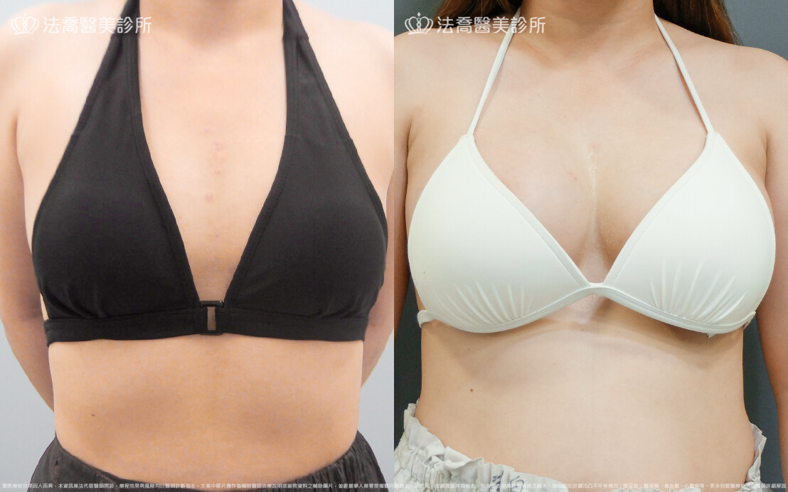 法喬醫美診所,邱浚彥,魔滴隆乳