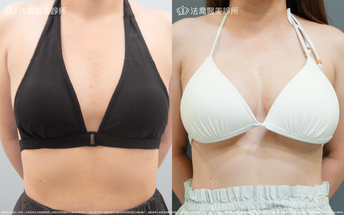 法喬醫美診所,邱浚彥,魔滴隆乳