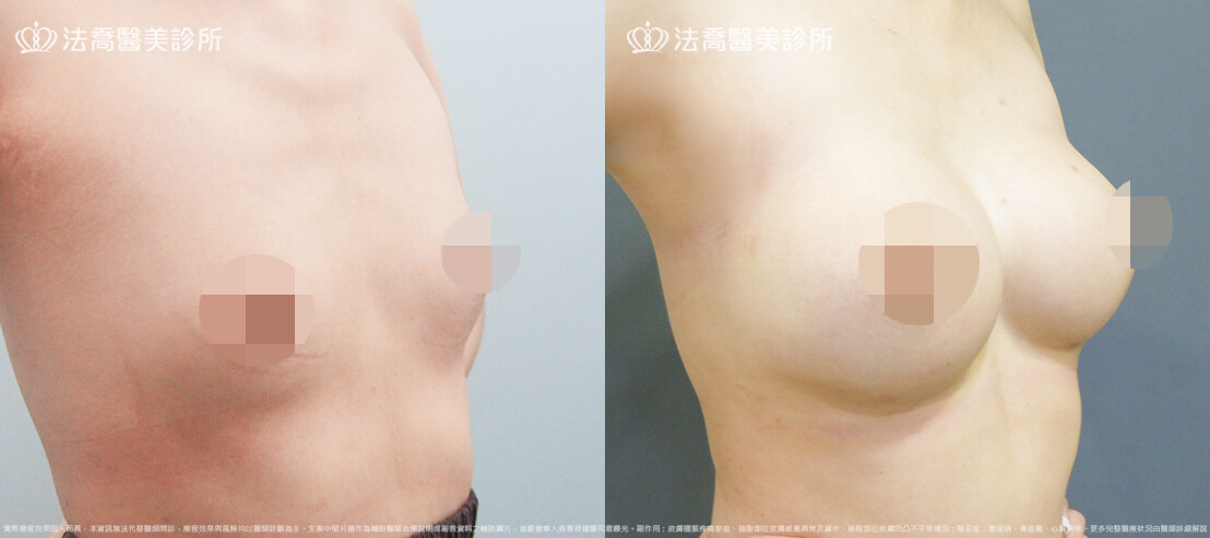 法喬醫美診所,邱浚彥,魔滴隆乳