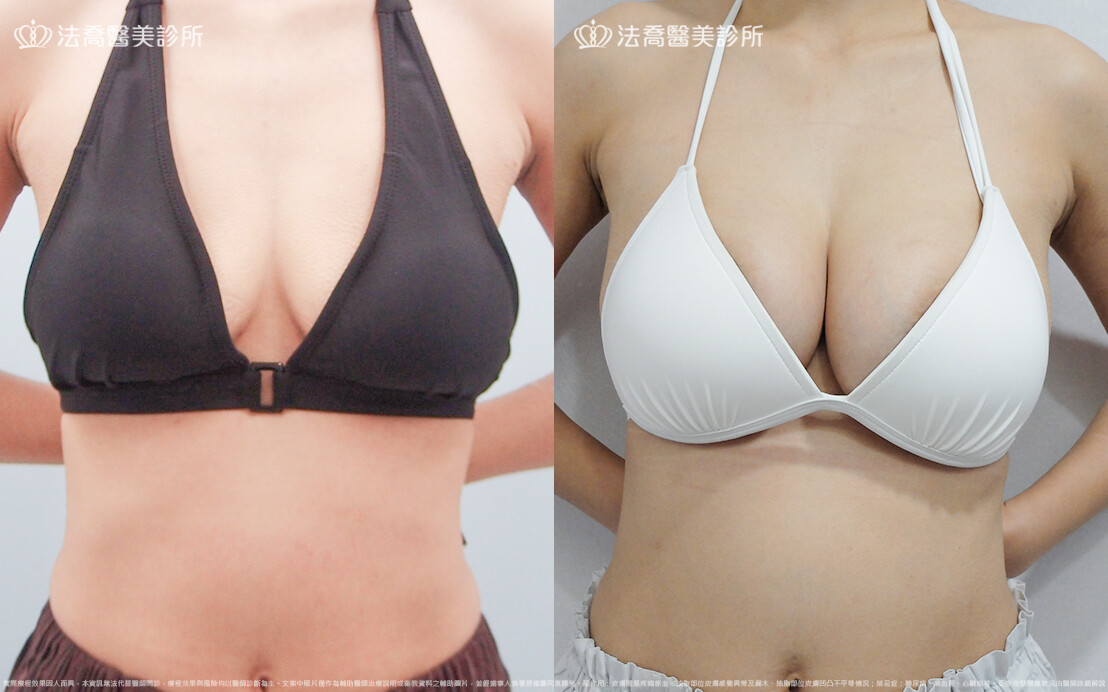 法喬醫美診所,邱浚彥,魔滴隆乳