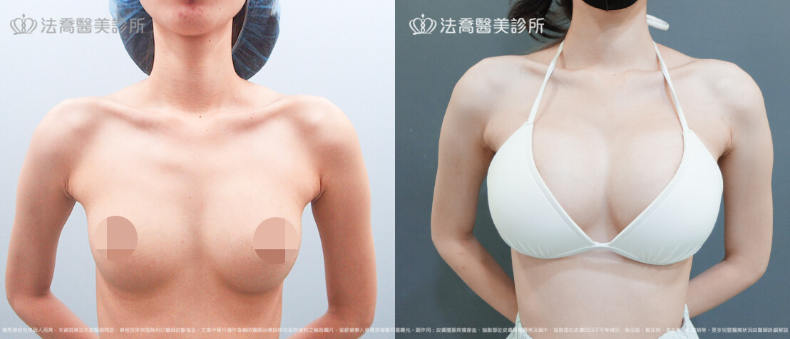 法喬醫美診所,邱浚彥,魔滴隆乳