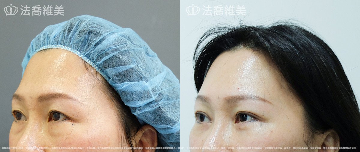 法喬醫美診所,邱浚彥,內視鏡前額五爪拉皮