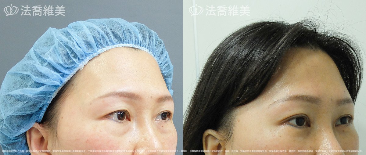 法喬醫美診所,邱浚彥,內視鏡前額五爪拉皮