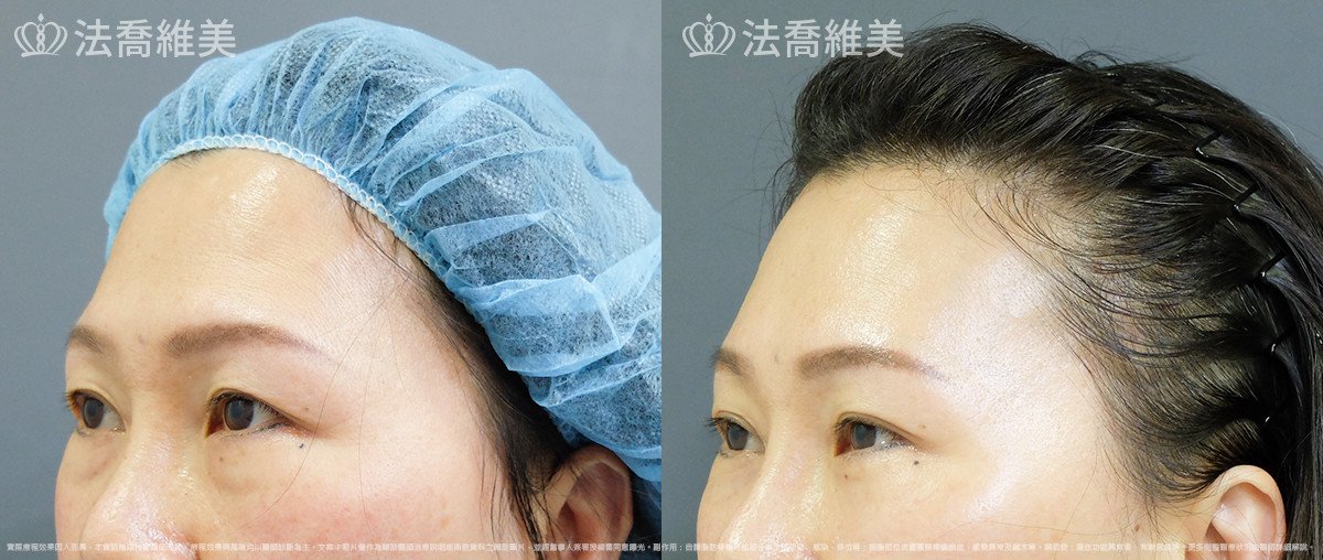 法喬醫美診所,邱浚彥,內視鏡前額五爪拉皮