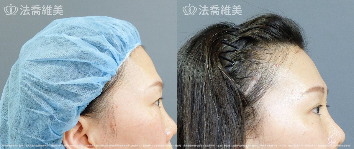 法喬醫美診所,邱浚彥,內視鏡前額五爪拉皮