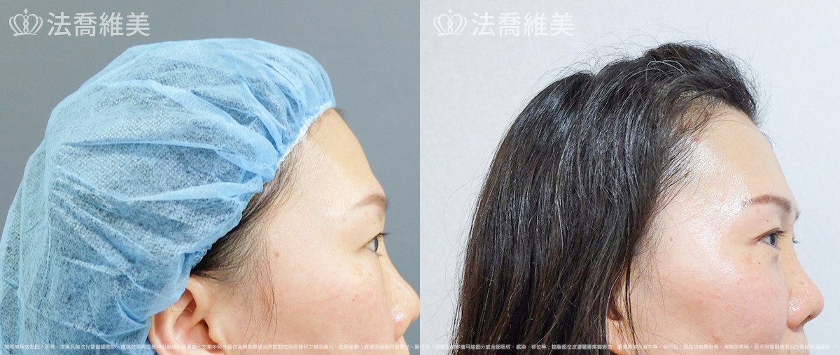 法喬醫美診所,邱浚彥,內視鏡前額五爪拉皮