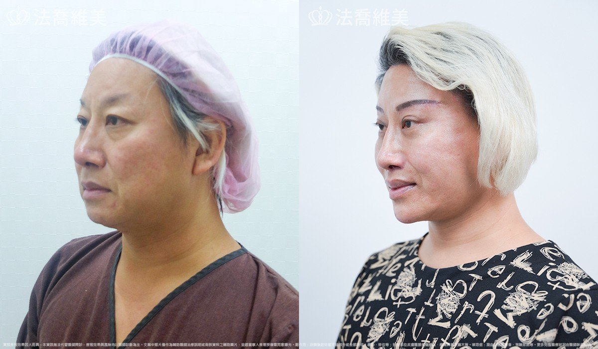 中下臉深部筋膜拉皮,法喬醫美診所,邱浚彥