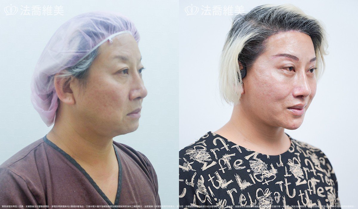 中下臉深部筋膜拉皮,法喬醫美診所,邱浚彥