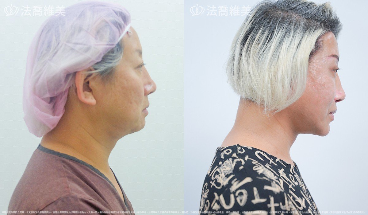中下臉深部筋膜拉皮,法喬醫美診所,邱浚彥