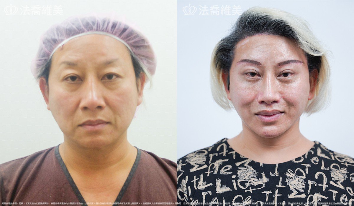 中下臉深部筋膜拉皮,法喬醫美診所,邱浚彥