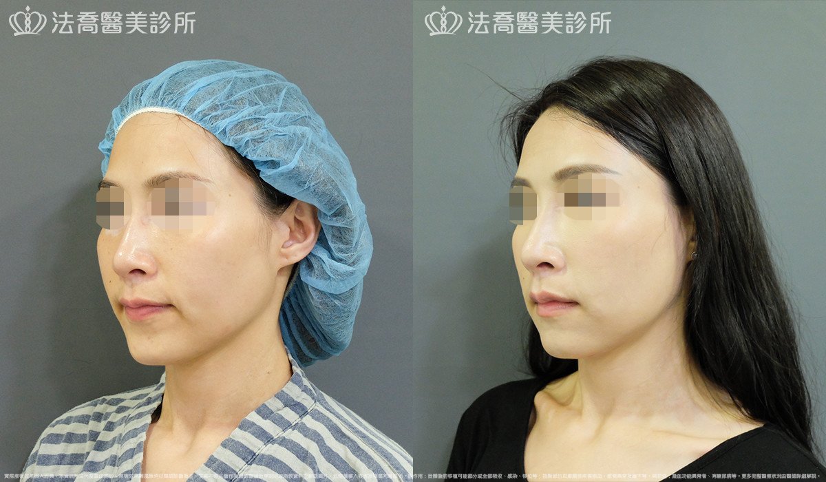 法喬醫美診所,邱浚彥,自體豐全臉