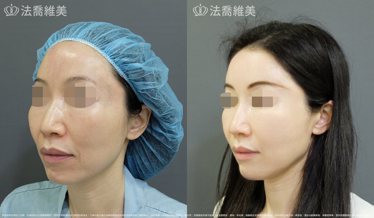 自體脂肪豐全臉