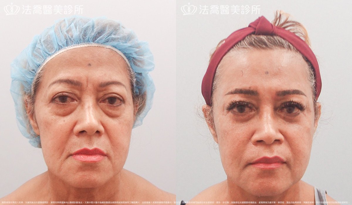 法喬醫美診所,邱浚彥,自體豐全臉