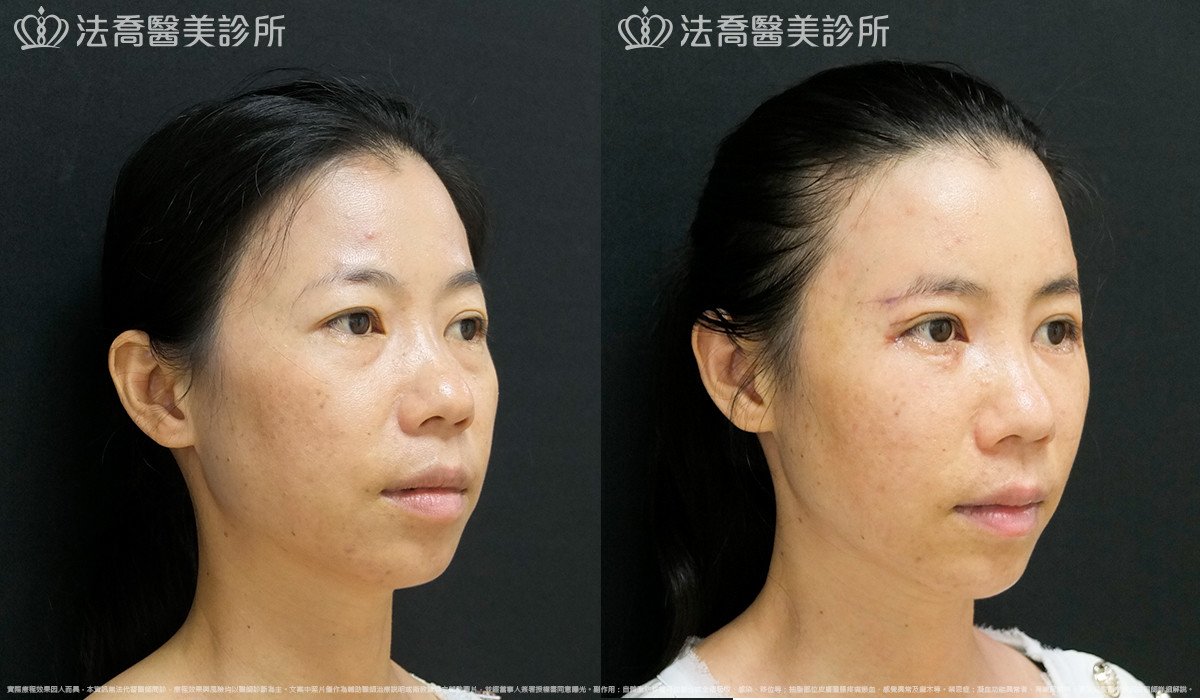 法喬醫美診所,邱浚彥,自體豐全臉