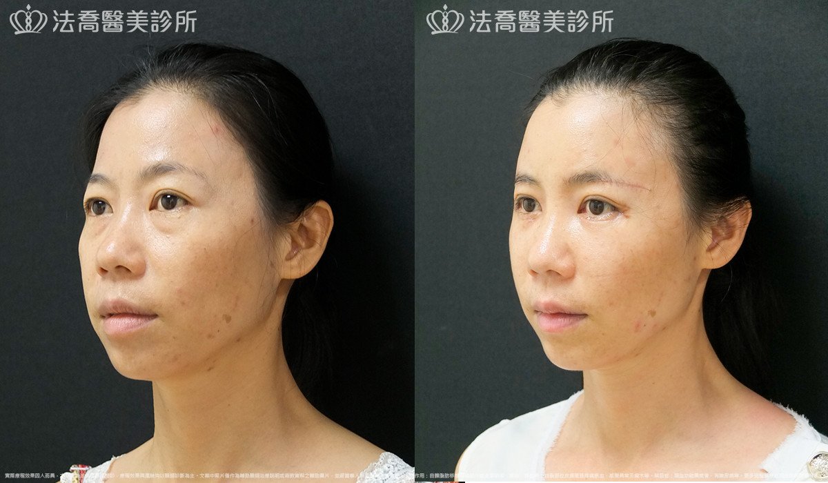 法喬醫美診所,邱浚彥,自體豐全臉