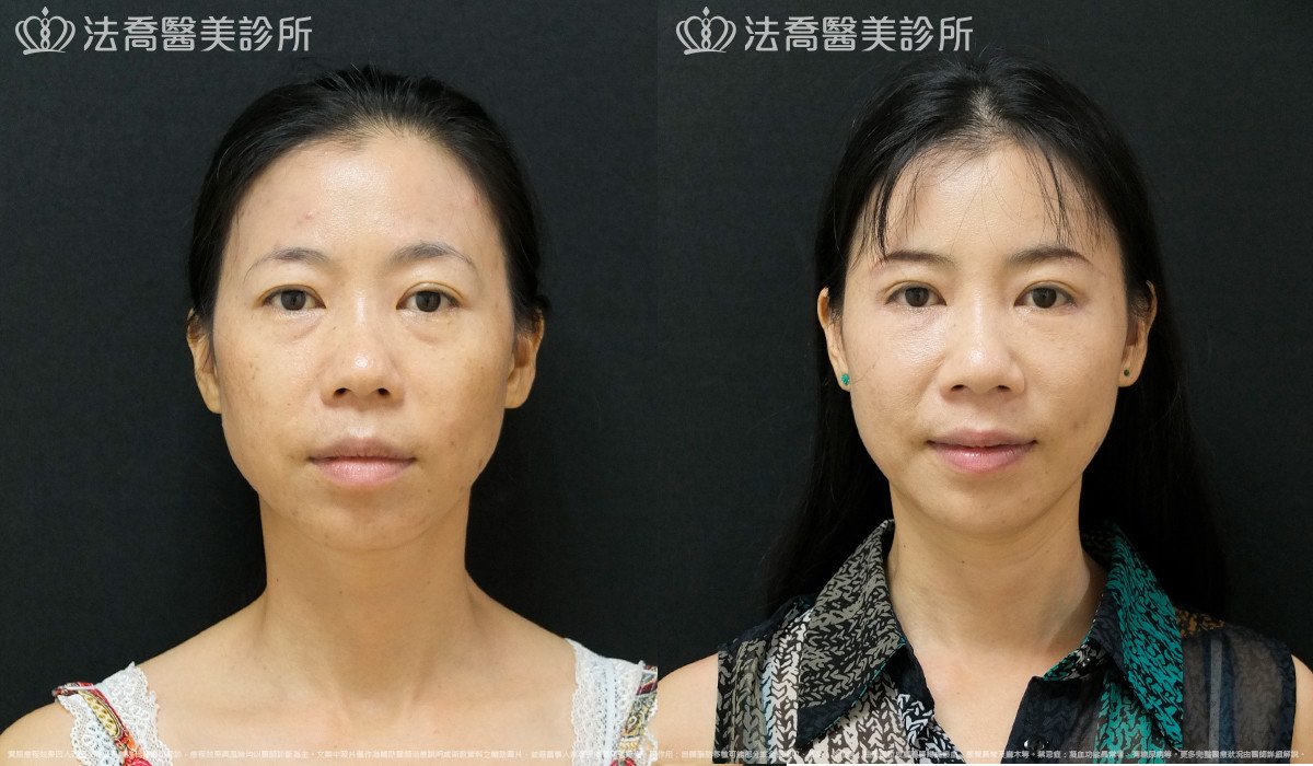 法喬醫美診所,邱浚彥,自體豐全臉