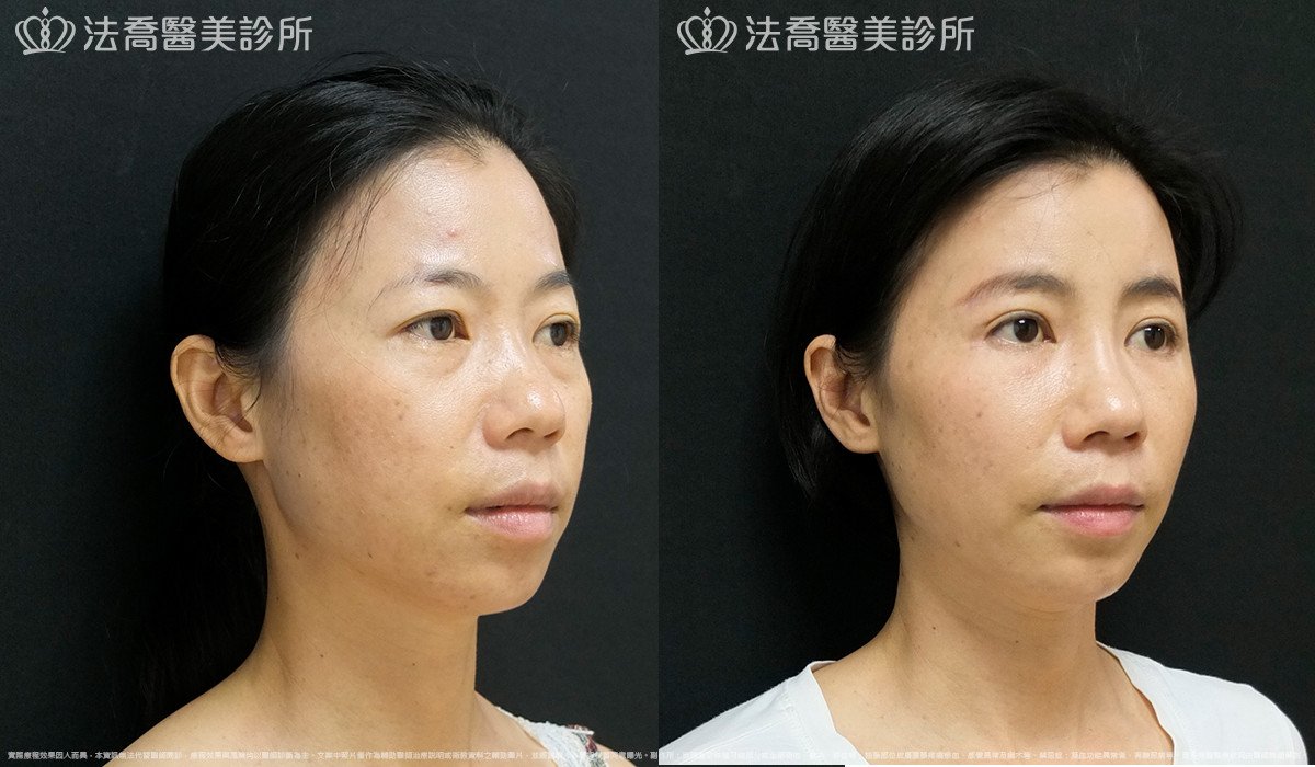 法喬醫美診所,邱浚彥,自體豐全臉