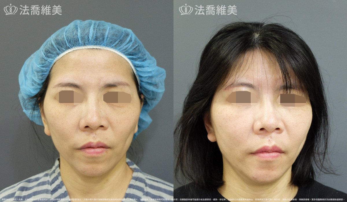 法喬醫美診所,邱浚彥,自體豐全臉