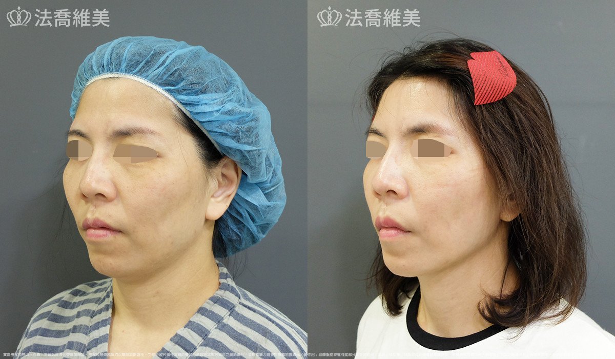 法喬醫美診所,邱浚彥,自體豐全臉