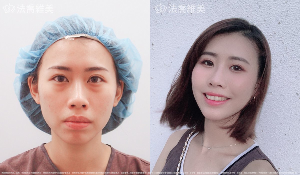 法喬醫美診所,邱浚彥,自體豐全臉