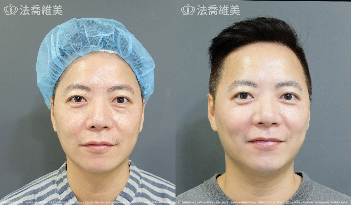 法喬醫美診所,邱浚彥,自體脂肪補蘋果肌及法令
