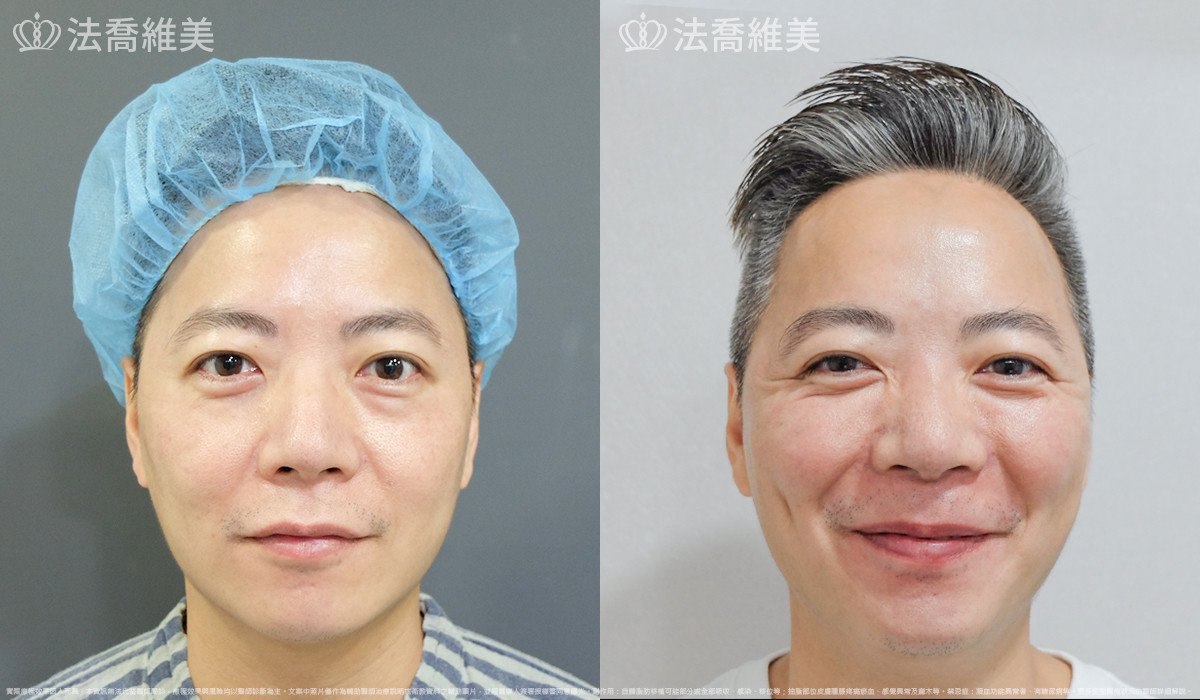 法喬醫美診所,邱浚彥,自體脂肪補蘋果肌及法令